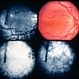 Foveal Hypoplasia